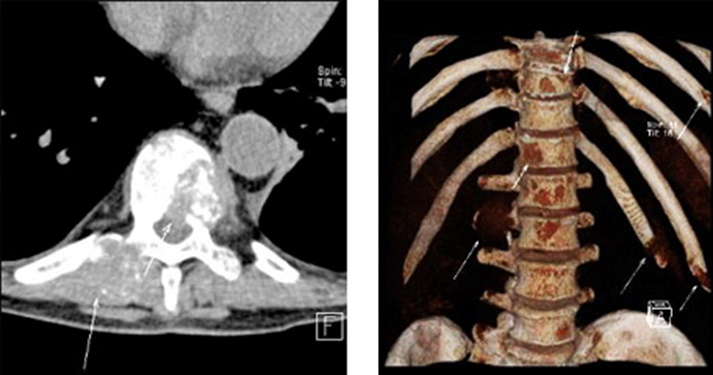 Метастаз грудного отдела. Метастазы в костях позвоночника на кт. Метастазы в тела позвонков кт. Остеолитические метастазы в позвоночник на кт.